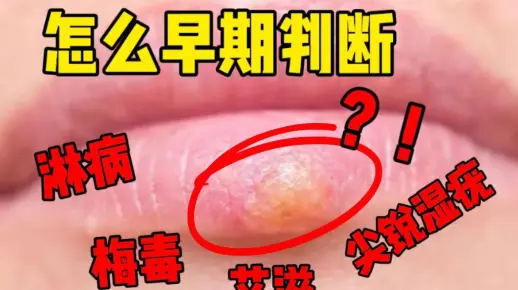 自测请进：除了艾滋，如何判断自己有没有感染性病？