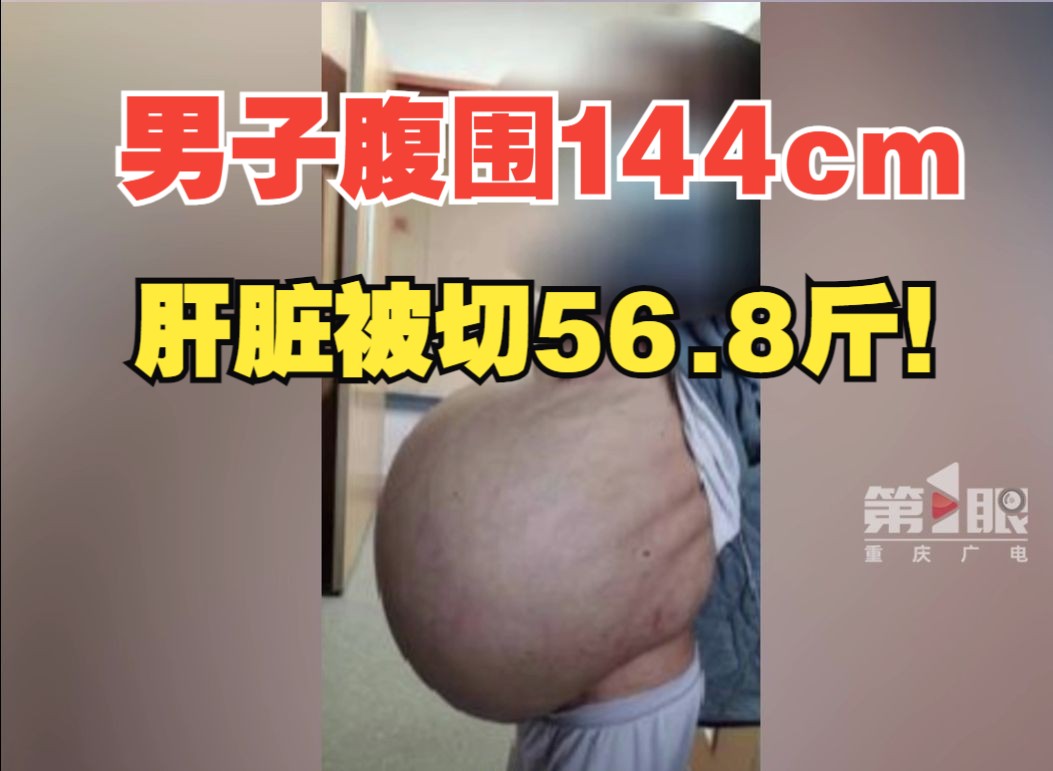 全球罕见！男子腹围144厘米手术切除肝脏56.8斤，术后直言如新生