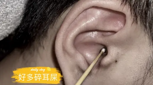 专业掏耳朵，聊天过程太开心，帅哥耳朵外面长出来好多耳皮经过慢慢能处理 终于干净