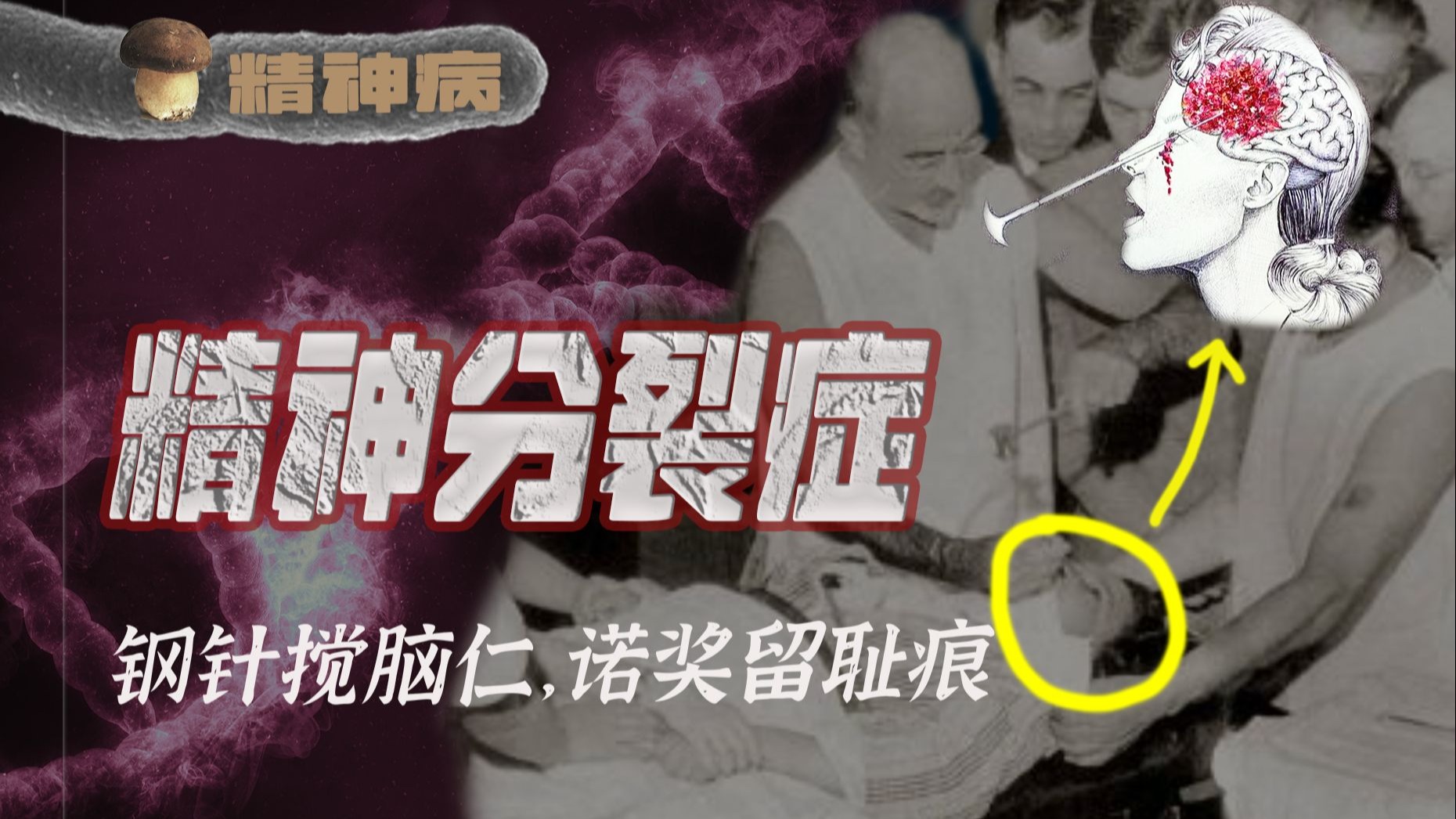 从高速旋转椅到钢针搅脑仁，精分是如何地狱化患者的世界的？【精神病系列02-下】