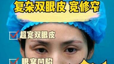 超复杂的<em class="keyword">双眼皮修复</em>，<em class="keyword">宽修窄</em>没那么简单