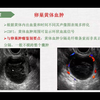 妇科疾病的超声诊断