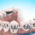 传统牙齿矫正过程，还在担心的牙齿不齐的可以了解一下！
