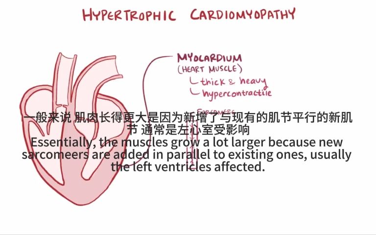 肥厚性心肌病HCM 字幕翻译版