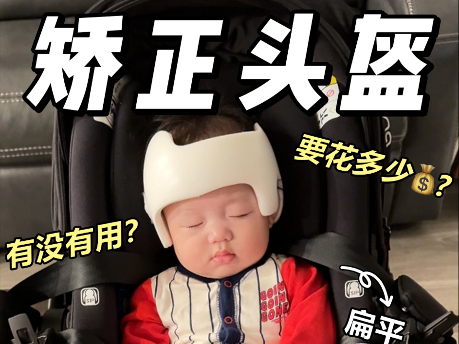 美国婴儿头型矫正流程分享，到底有没有用？