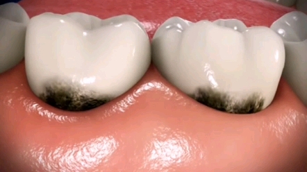90％以上的龋齿（蛀牙，虫牙）发生在磨牙（后槽牙）上面，这些位置是最容易发生龋齿的部位。