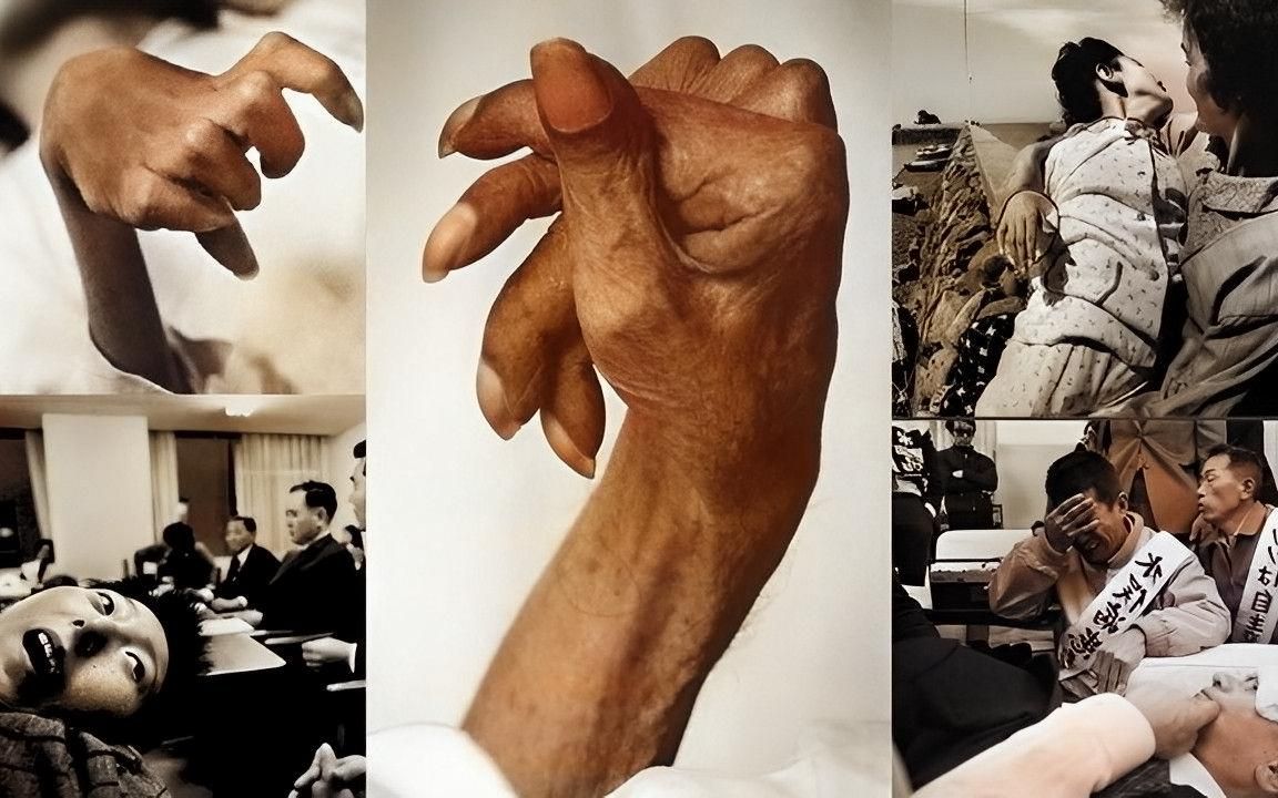 1956年日本水俣病真实录像，患者身体弯弓高叫，唯有死亡才能解脱