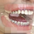 隐形透明的牙套治疗过程！