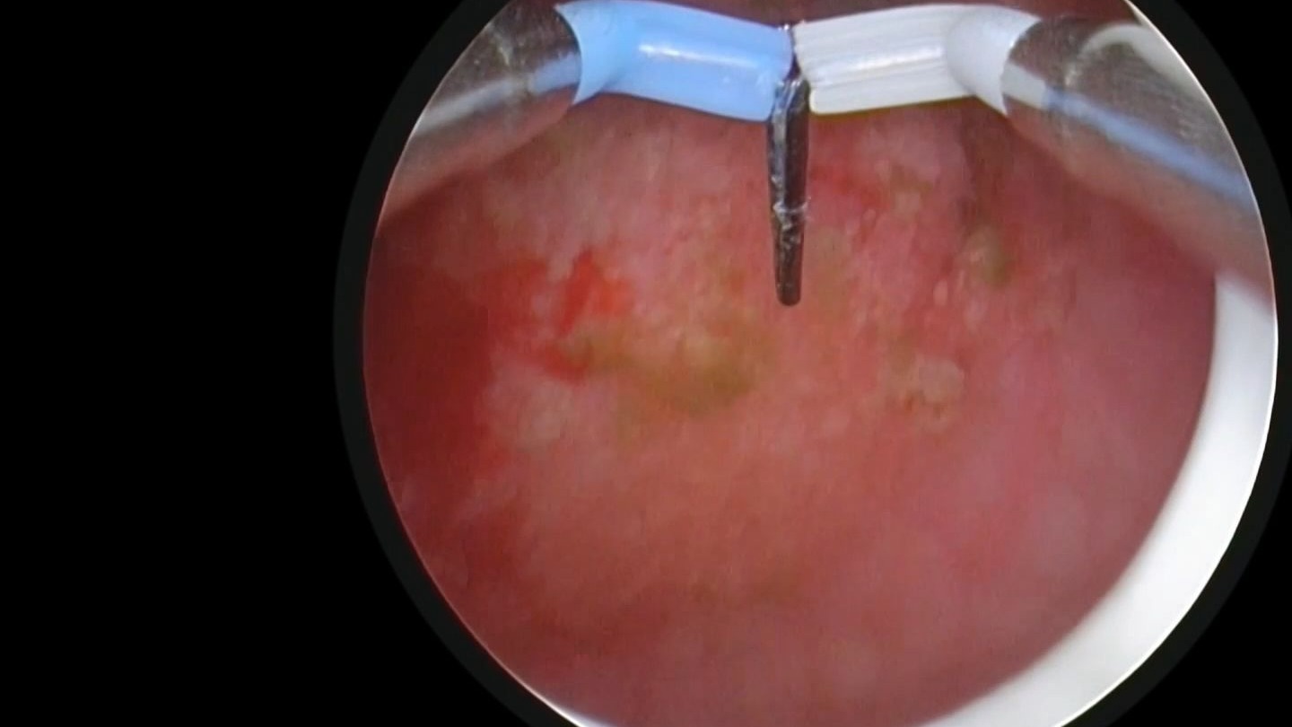 经尿道膀胱肿瘤切除术