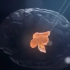 【无影灯下】看点8-4：向大脑植入微米电极，14年帕金森患者得到治疗
