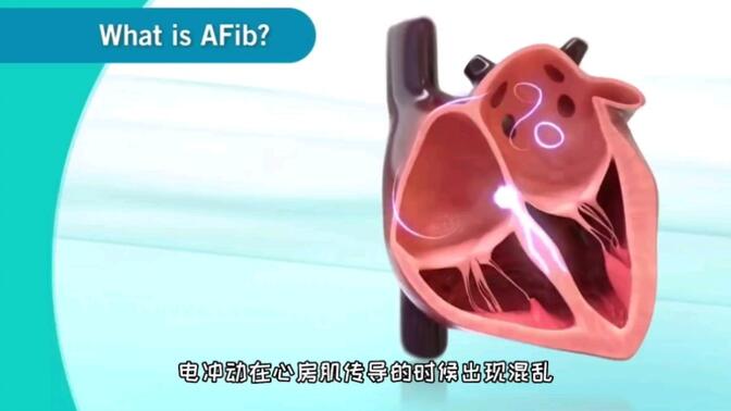 房颤的发生原因，3D演示。。