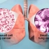 【医学动画】了解肺癌的形成Understanding Lung Cancer