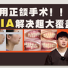 不用做正颌手术，面下三分之一改变太大了