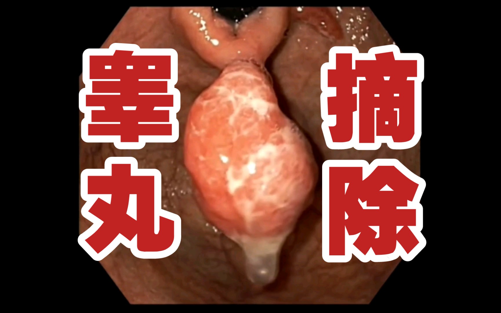 胃里长了个“睾丸”，医生如何用胃镜摘除！？