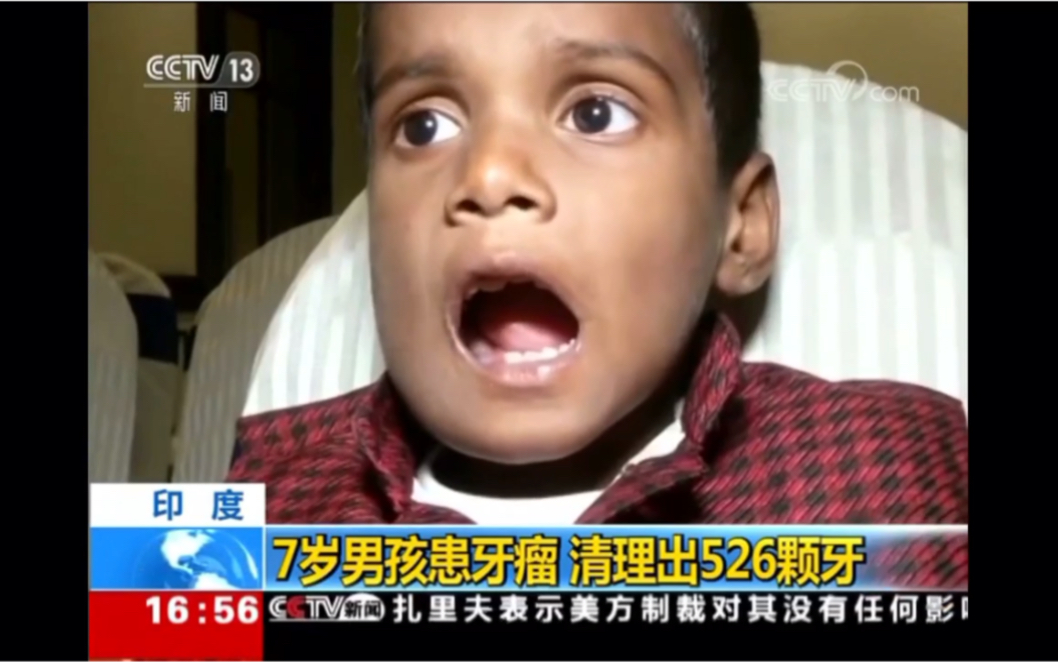 吓人！7岁男孩患牙瘤，医生手术取出526颗牙齿