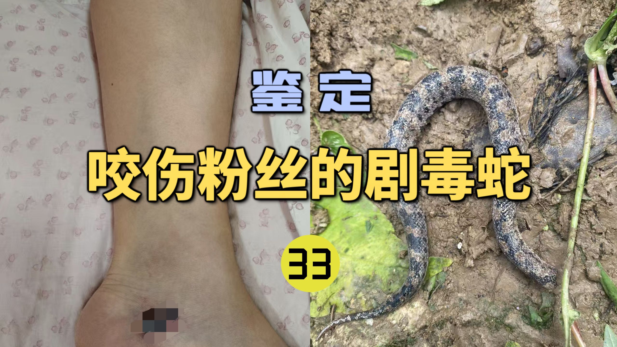 鉴定咬伤粉丝的毒蛇(33)粉丝的妈妈被不明毒蛇咬伤后凝血崩溃！血清还打错了？