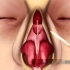 3D全方位演示隆鼻手术过程。