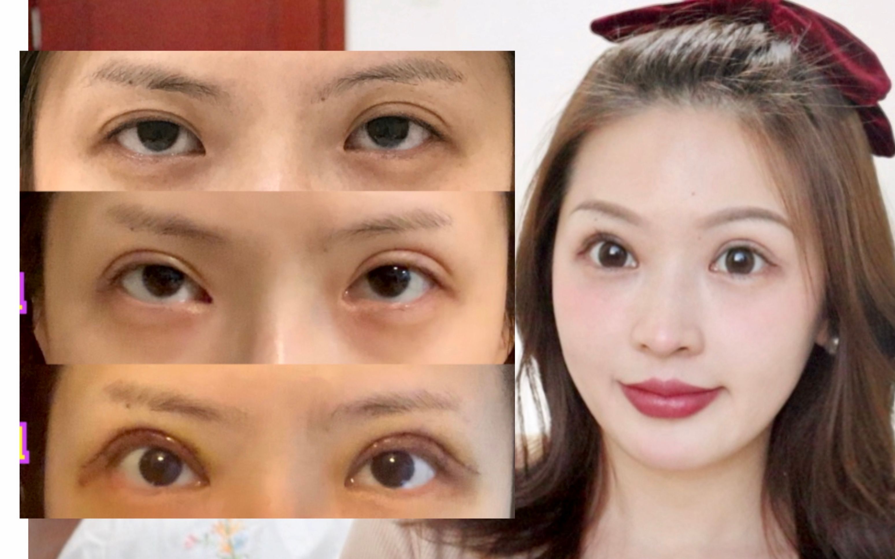 【33】10w元双眼皮分享 史上最全眼综合攻略 提高手术成功率！