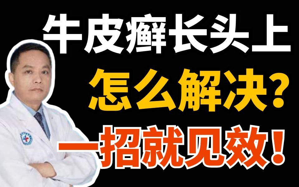 牛皮癣长头上又痒又难受?有好办法!