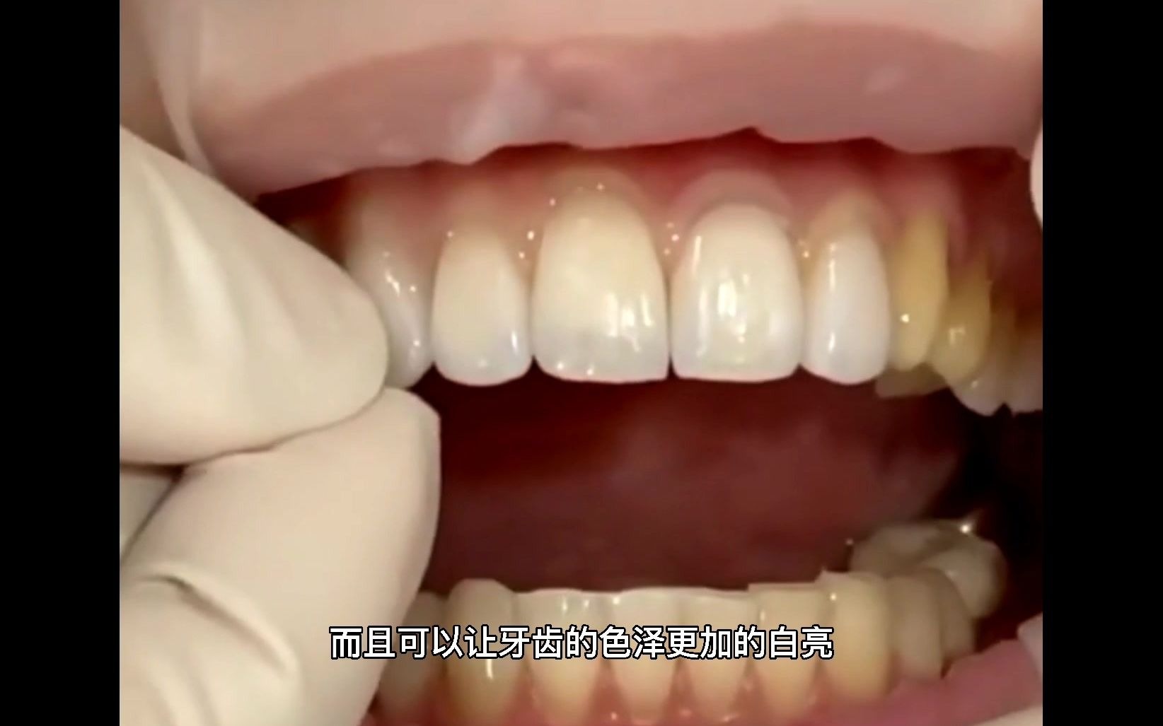 牙齿表面黄色的软垢是什么？怎么清理效果最佳？专家给出办法 - 知乎