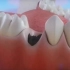 蛀牙只剩牙残根了怎么办？