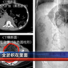 高中女生，一次拉出8斤粪便