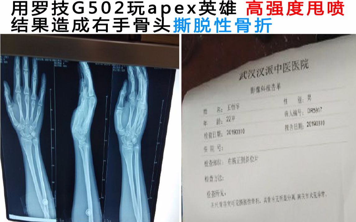 玩apex英雄玩到右手骨头撕脱性骨折 ﾟdﾟ ﾟdﾟ 网上让人笑到窒息的沙雕梗 第141期 哔哩哔哩