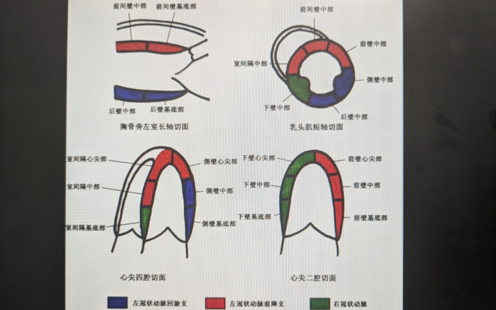 室壁运动异常识别一