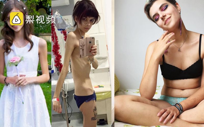 美女减肥过度差点死掉，增肥后因赘肉走红