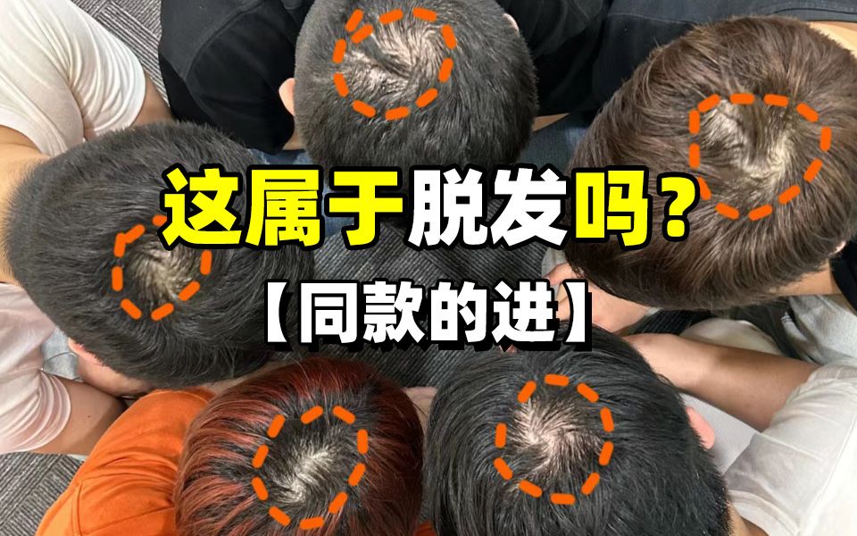 头顶稀疏到什么程度算脱发？应该怎么治？