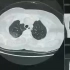 【医学生】新冠肺炎的CT影像变化