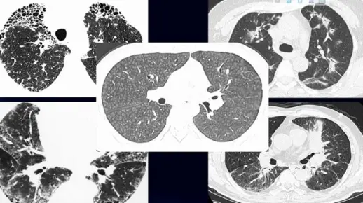 2.肺部弥漫性病变的影像分布趋势-胸部影像诊断思维训练营系列3
