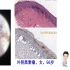 中国人第二常见的黑素瘤类型：粘膜型黑素瘤