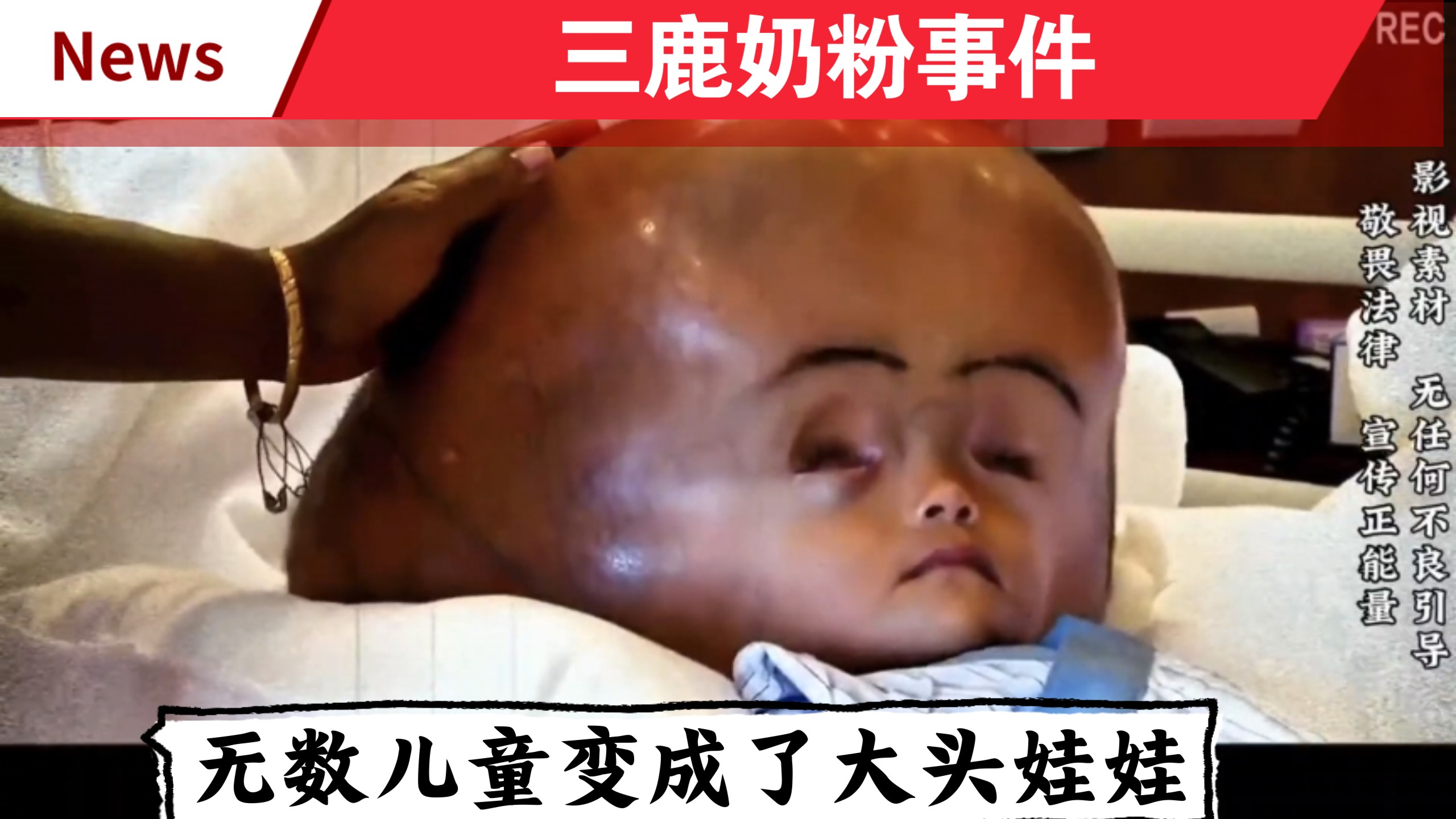 河北·石家庄:三鹿奶粉事件，无数儿童变成了大头娃娃！