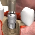 牙齿手术合集，蛀牙的感染、修补蛀牙、种牙手术的过程