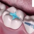 今日分享视频    牙齿龋坏咬合面补牙修复方式