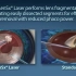 BladelessLaser Cataract Surgery with the LenSx Vs Standard T