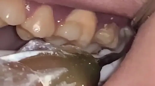 牙结石是怎么洗掉的？