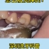 牙结石是怎么洗掉的？