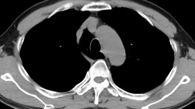 一种少见的肺组织变异，报告怎么书写？