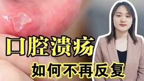喝哪种水能治口腔溃疡 983a2a42a38a0f6631b0f915a53f7fbf81a2b2f9.jpg@280w_158h_1c_100q.jpg