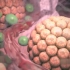 3D动画演示甲状腺结节的发病过程