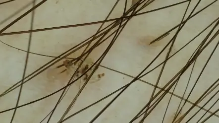 阴虱是什么引起的#虱子卵 #虱子 #阴虱