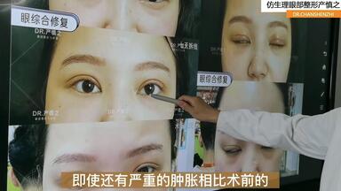 宽改窄、提肌重组——一台极具挑战性的<em class="keyword">双眼皮修复</em>