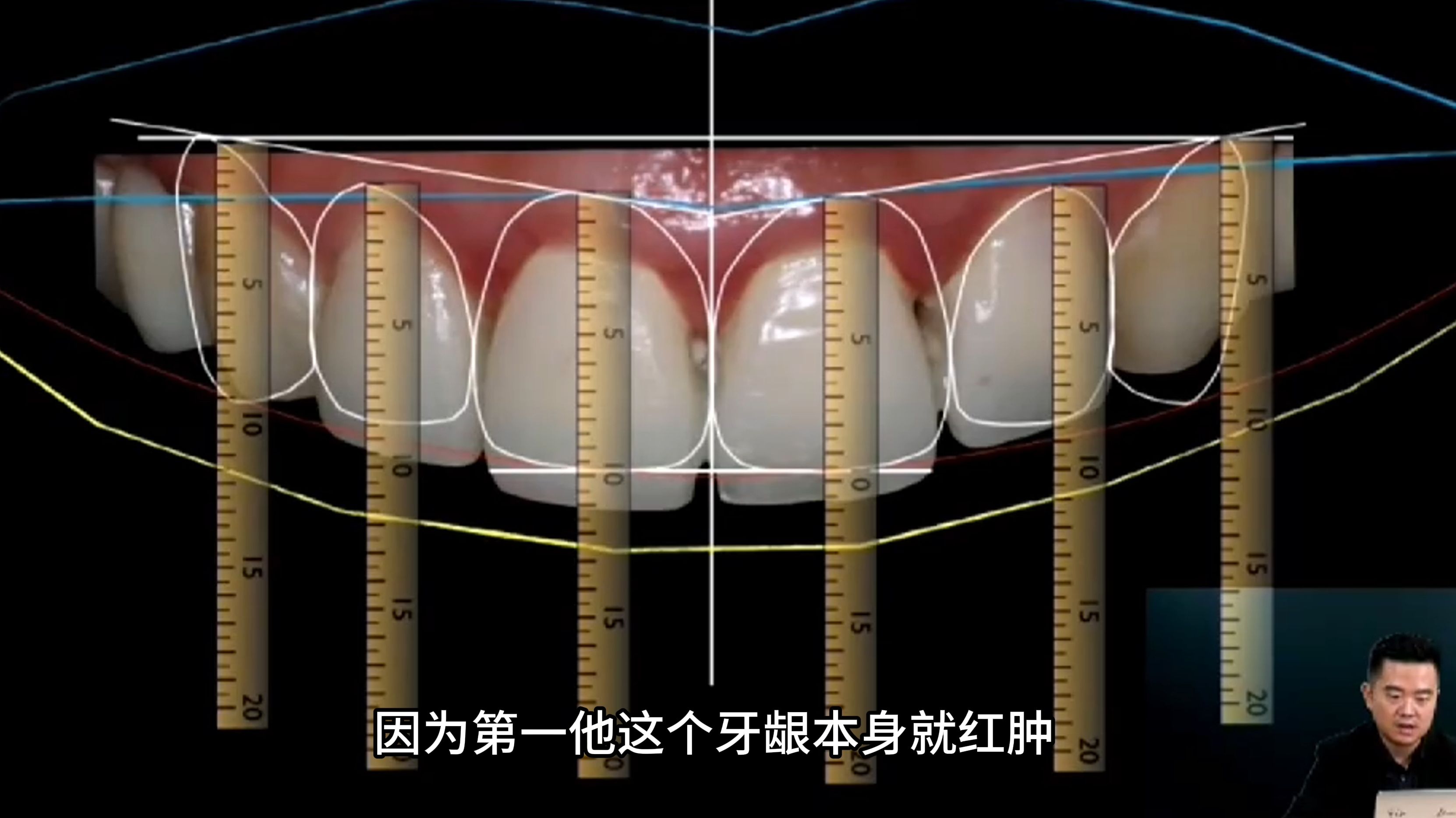 【张林】5天学会做瓷贴面1——美学分析及基本理论