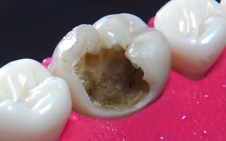 龋齿受损，牙齿的惊人修复过程！超清 牙冠