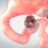 就是接水管，十二指肠肿瘤切除术，3D演示。。