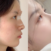 肋骨鼻综合，术后6个月变美过程