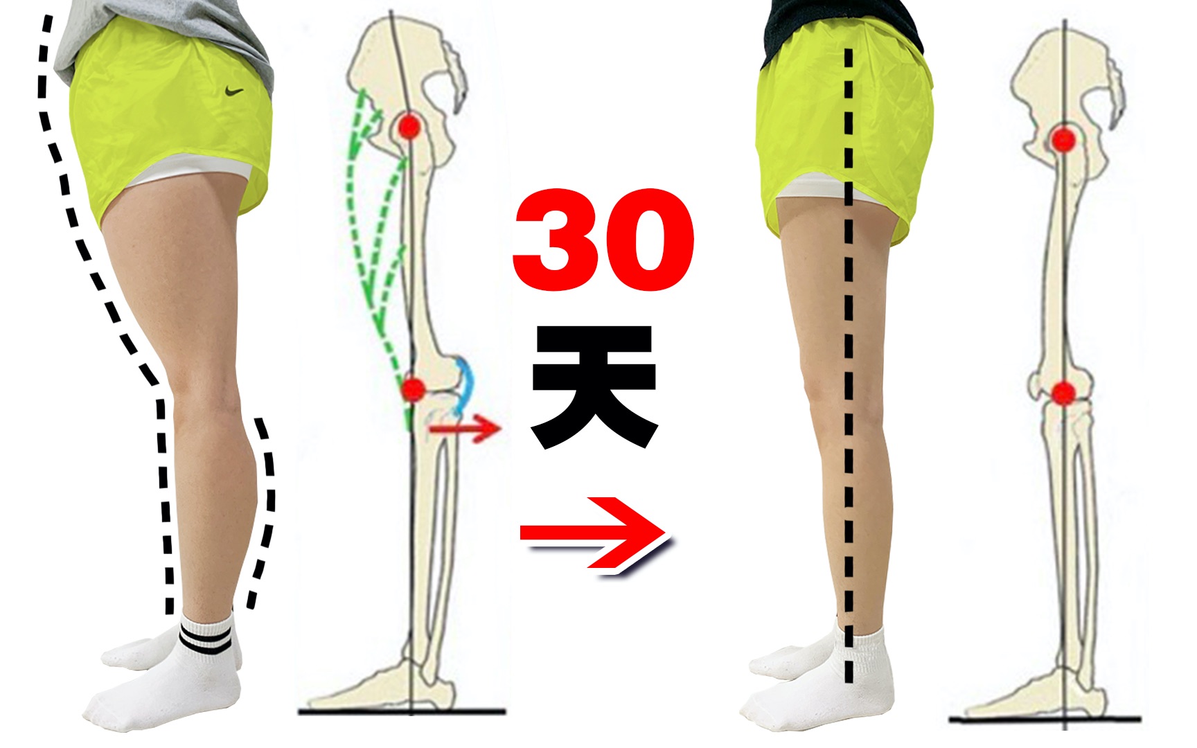 大腿外侧突出该怎么解决？
