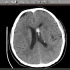 CT入门教学（三）：脑出血在CT上表现及出血量的估算